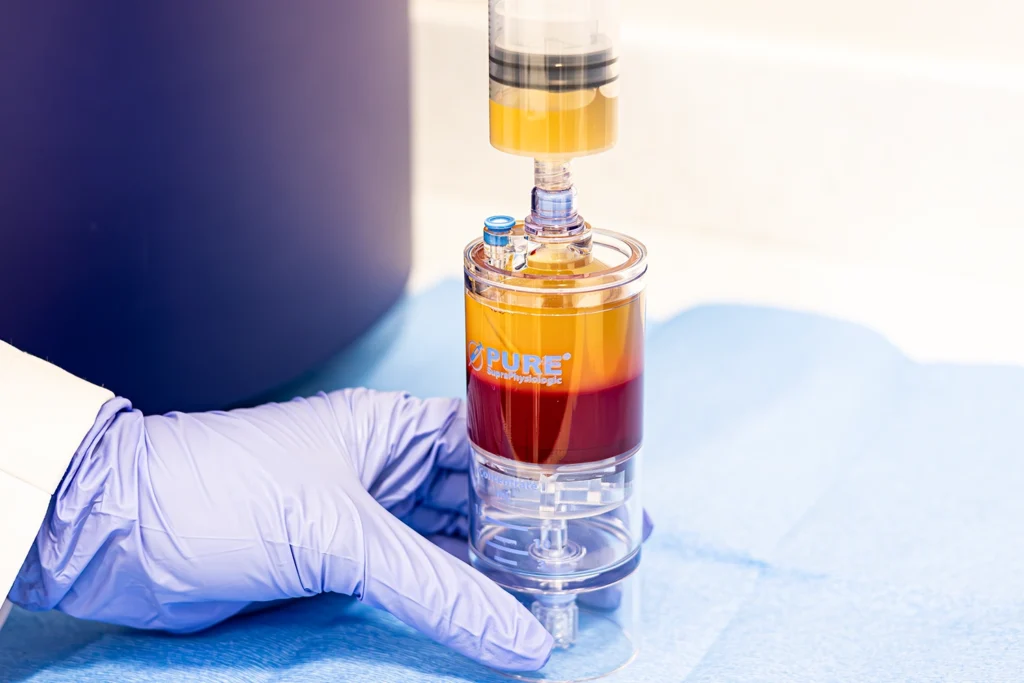 A gloved hand steadying a PURE SupraPhysiologic concentrating device on a sterile field, the drawn blood separated into a golden plasma layer above packed red cells.